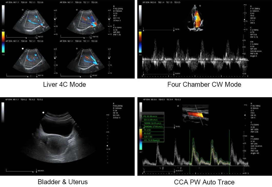 Sistema de ultrasonido cardíaco portátil con ecógrafo color Doppler para laptop