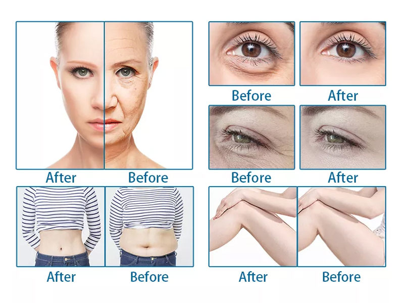 Equipo de belleza ultrasónico para el levantamiento facial antienvejecimiento, firmeza, eliminación de arrugas y adelgazamiento corporal Mptstl 12D Tt Hifu Machine