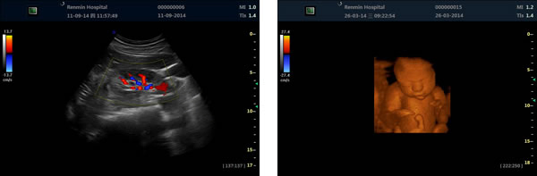 3D Ecografía Abdominal Escaneo Imagen Sonografía Ultrasonografía Sistema