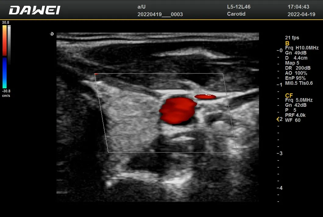 Carro médico de ultrasonido Doppler vascular