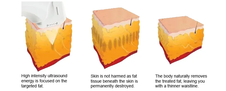 Body Slimming