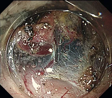 Endoscopy Feature 3