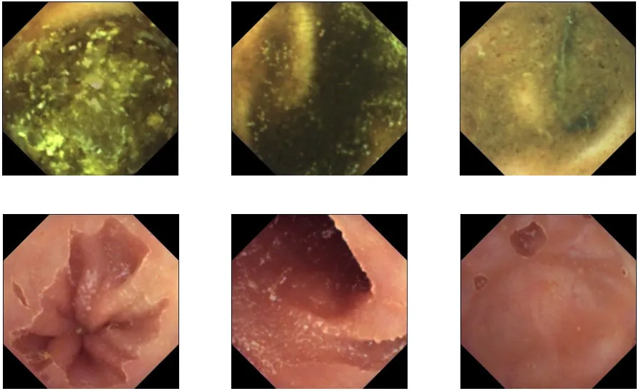 Uncleansed intestine