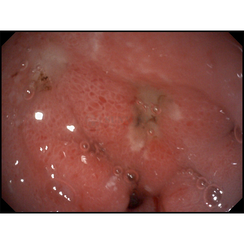 Sonoscape HD-350 Flexible Endoscopy System for Gastroscopy Colonoscopy