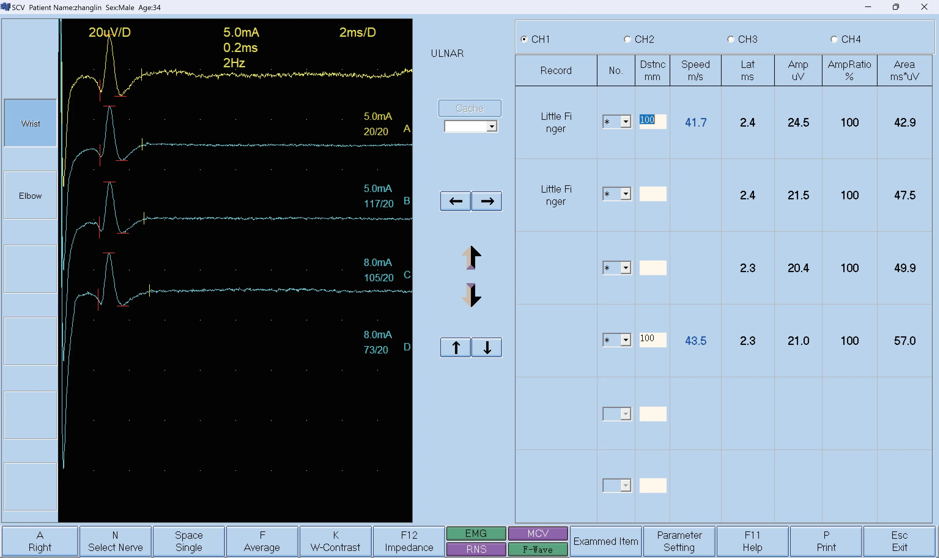 Professional Medical Equipment Electromygram Ep System Device Electromyography Emg Machine