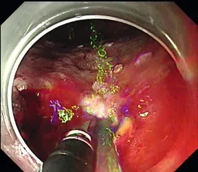 Endoscopy Feature 2