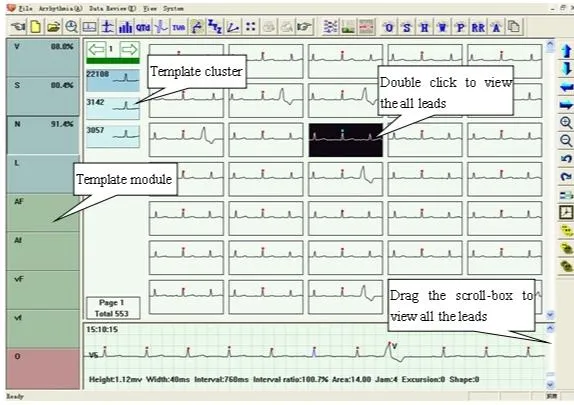 ECG Telemedicine System