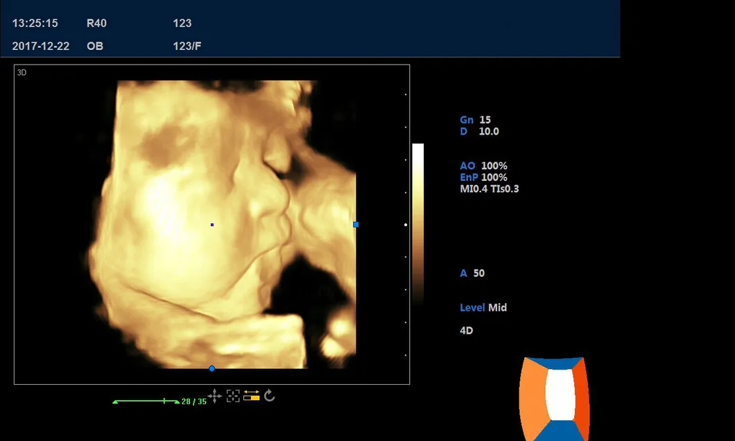 4D Fetus Face