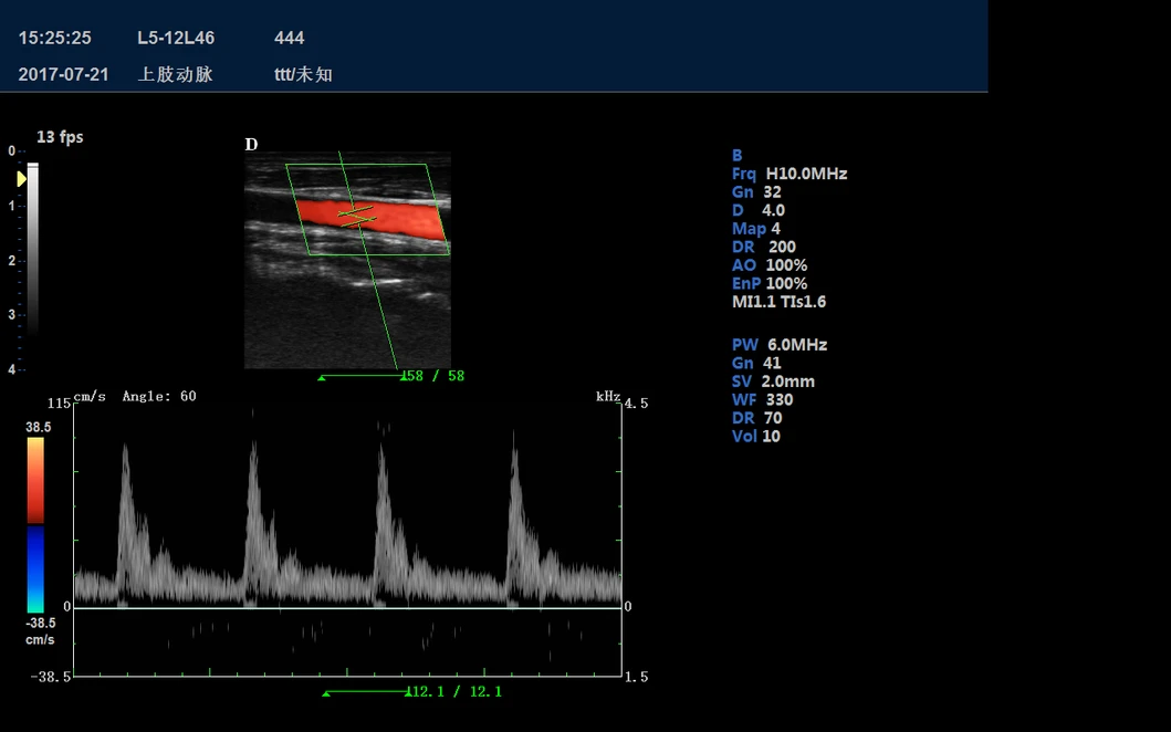 Carotid Artery