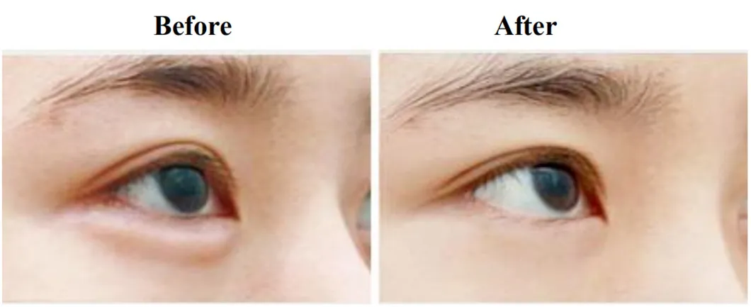 RF Eye Lifting Machine Before After Treatment 2
