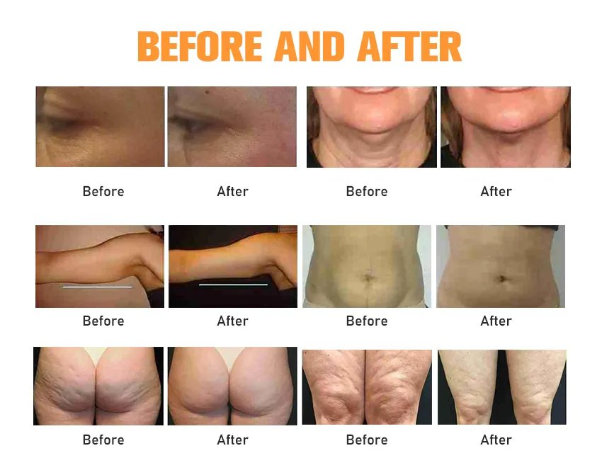 360 Vacuum RF Anti Cellulite Treatment 8d Endo Ball Roller Vacuum Massager Body Shape Endos Facial Neck Lifting Device