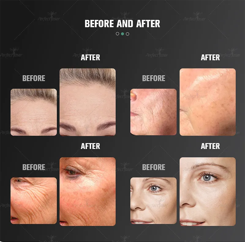 Before & After Face Lift Result