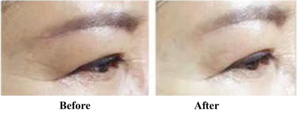 RF Eye Lifting Machine Before After Treatment 3