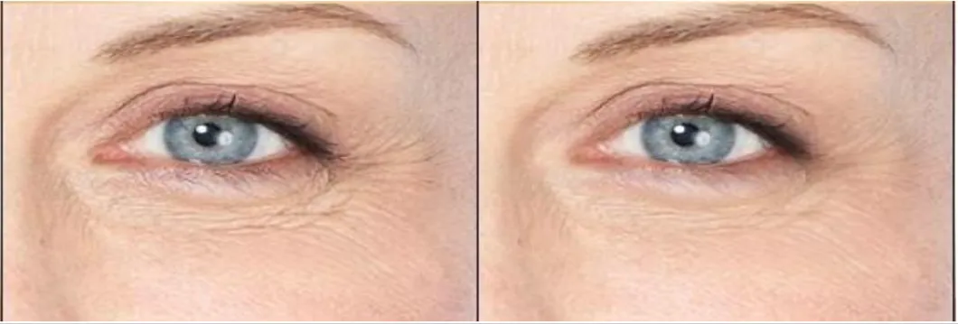RF Eye Lifting Machine Before After Treatment 1