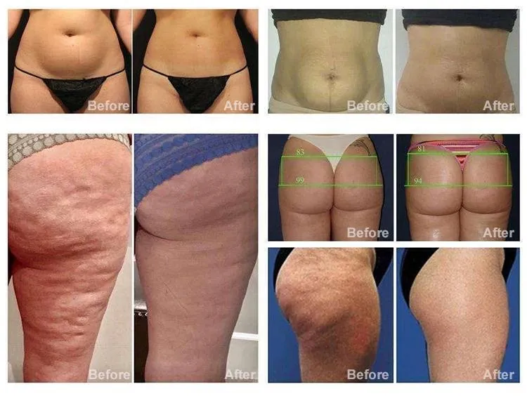 Body sculpting before after