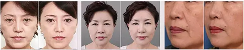 Ultrasound RF face body treatment application display