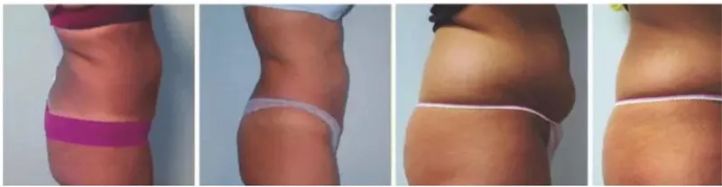Ultrasound RF skin tightening therapy effects