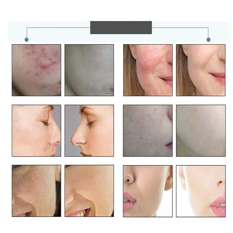 Portable Foldable LED Photon Therapy Skin Rejuvenation Facial Massager