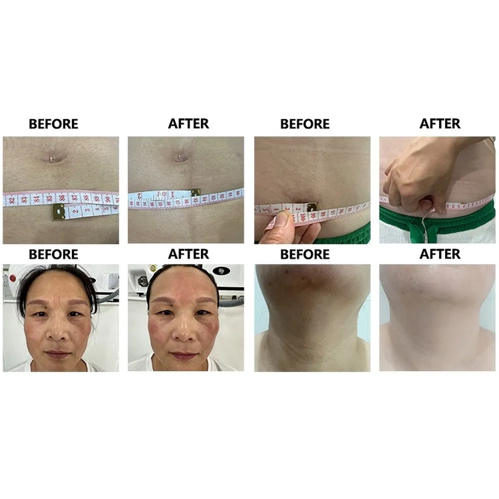 High Precision K380 RF Vacuum Slimming Machine with 3 Handles