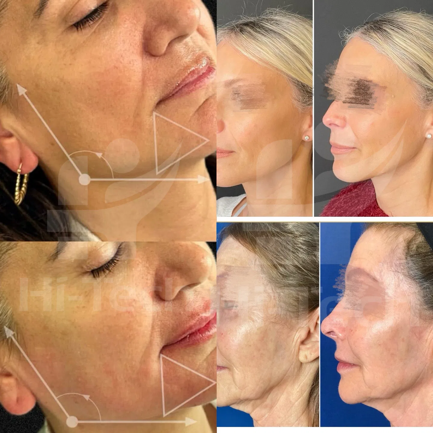 Injeção Caha de Alta Qualidade para Rejuvenescimento Facial e Hidratação