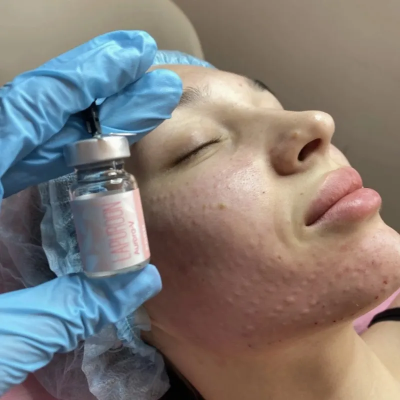 Lapuroon Aurora Vivid (5ml*5) Pdrn Hidratação Profunda e Firmadora da Pele Lapuroon Aurora Super Sódio DNA Pdrn