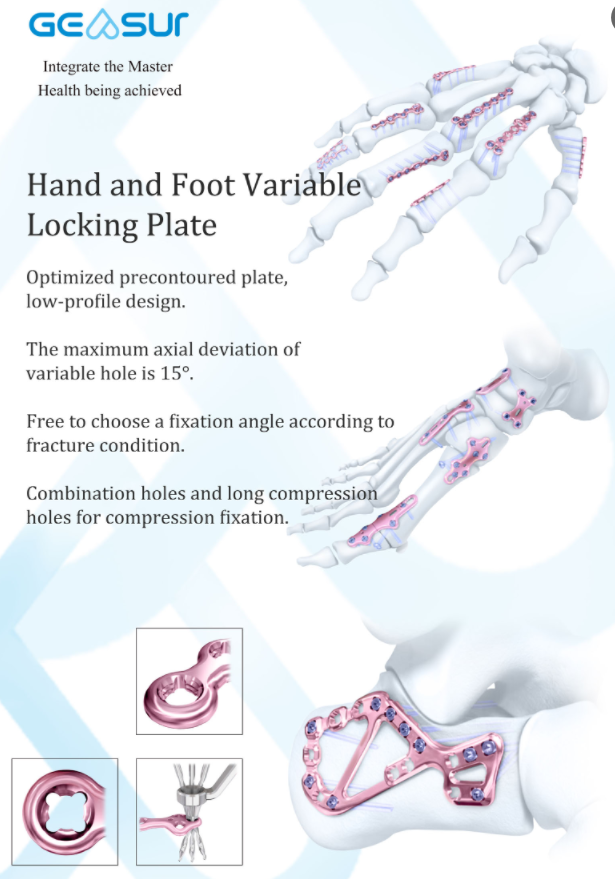 Volar Distal Radius Support Locking Plate Detail 1
