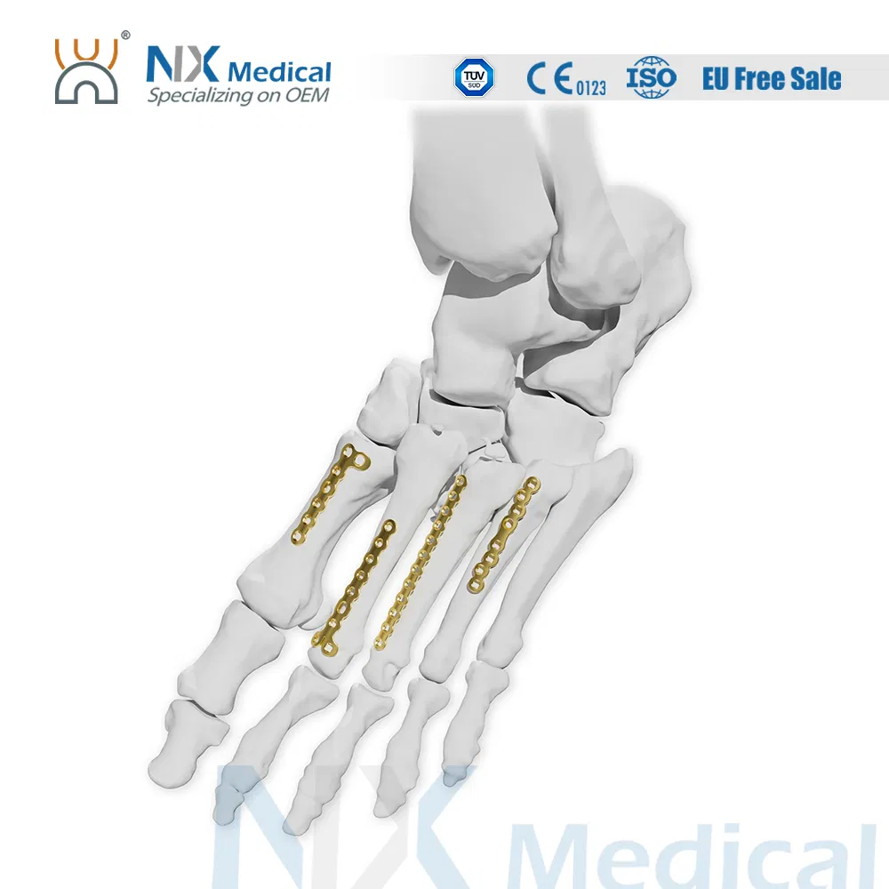 Nx Medical Titanium Orthopedic Bone Fracture Mini Fragment LCP Trauma Locking Compression Plate