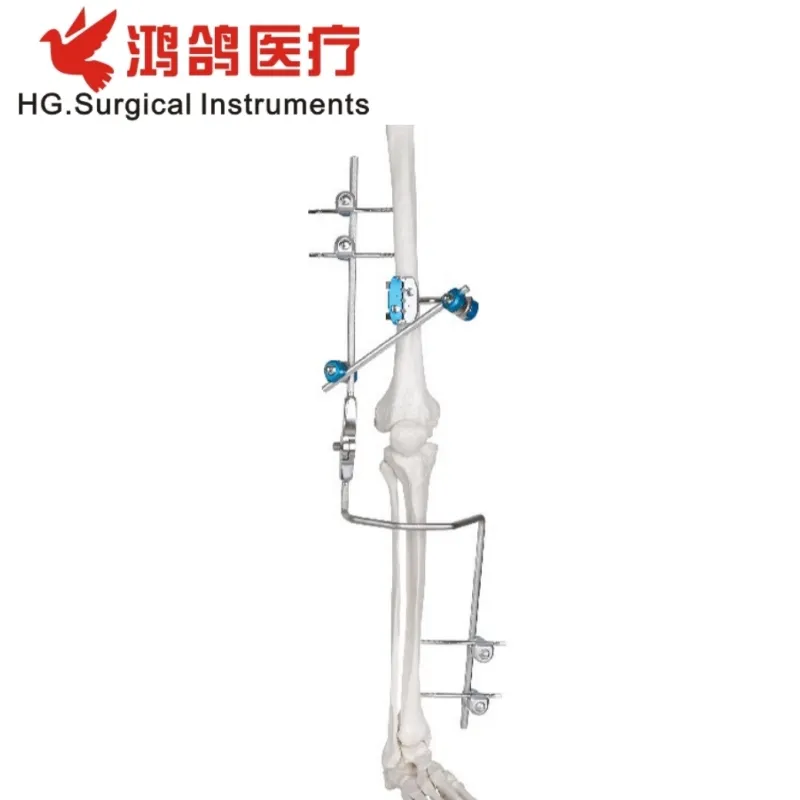 External Fixator Ankle Fusion Joint Fixator 1