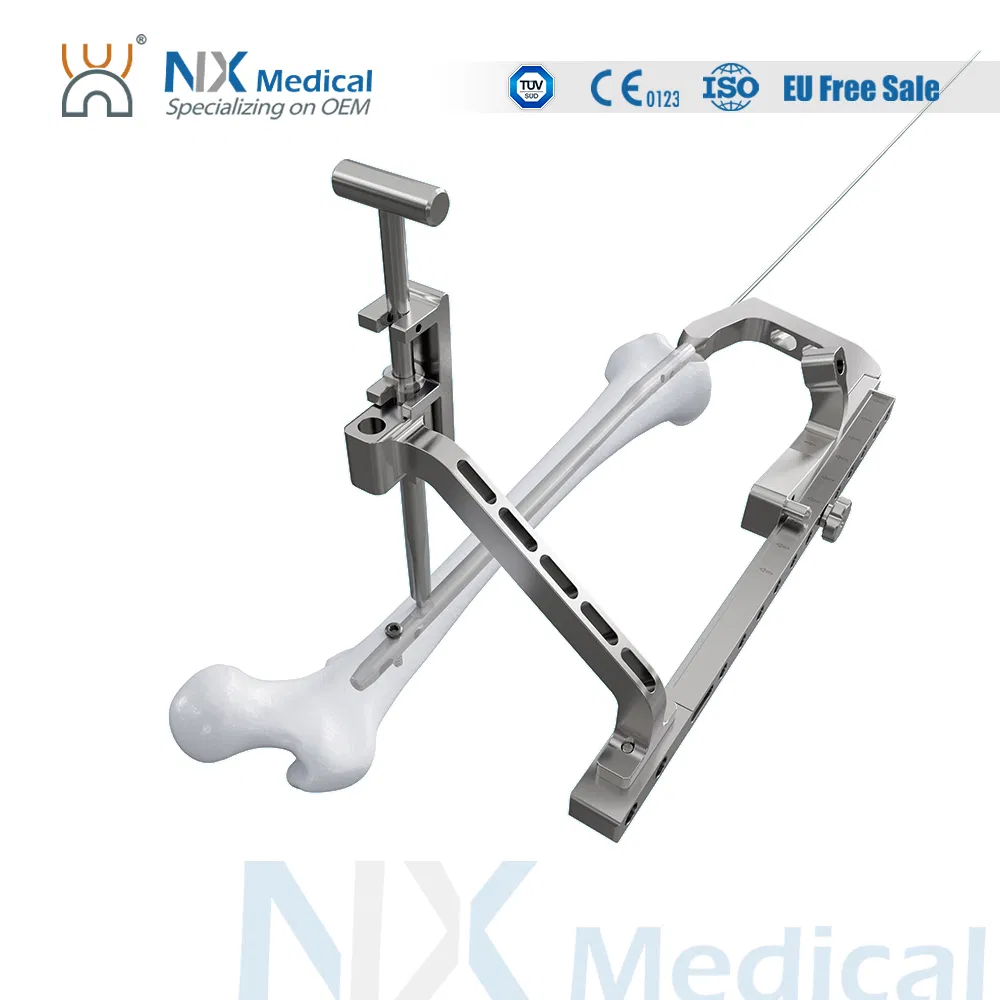 Nx Medical Retrograde Titanium Femoral Intramedullary Interlocking Nail System for Orthopedic Implants