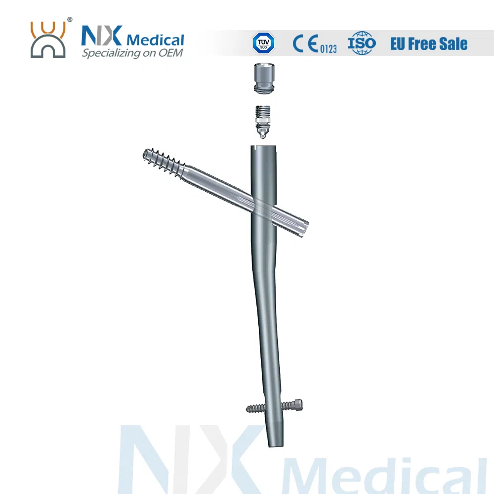Nx Medical Orthopedic Implant Proximal Femoral Interlocking Intramedullary Nail
