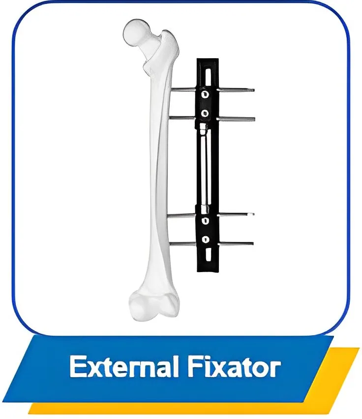 External Fixator