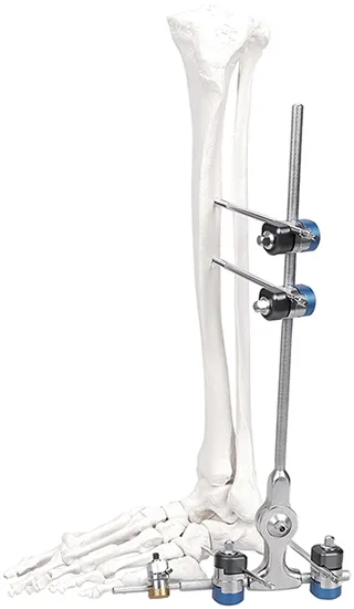 Ankle Fixator