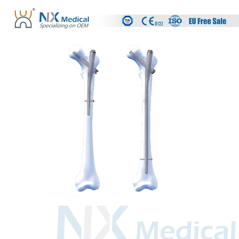 Nx Medical Orthopedic Implant Proximal Femoral Interlocking Intramedullary Nail