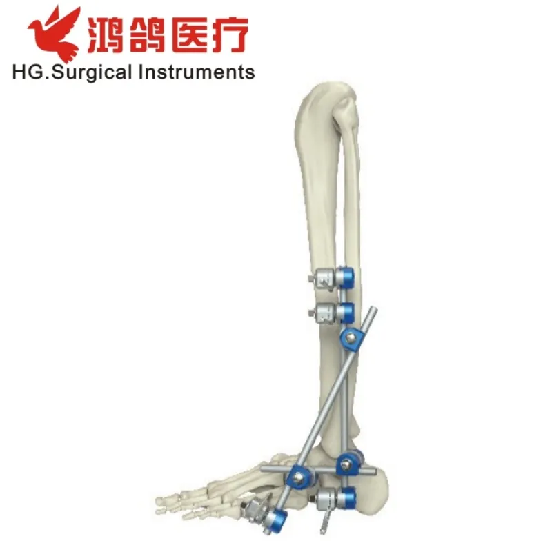 External Fixator Ankle Fusion Joint Fixator 3