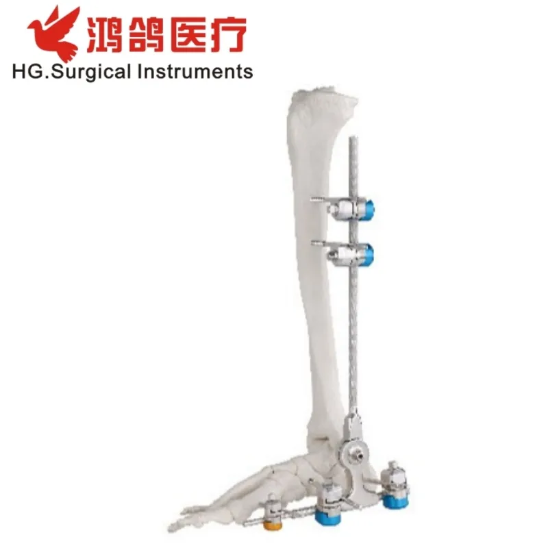 External Fixator Ankle Fusion Joint Fixator 2