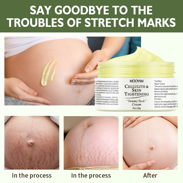 Organic Stretch Mark Removal Cream Body Tummy Tuck Repair Treatment Lotion Moisturizing Scar Removal Cream Shea Butter Herbal