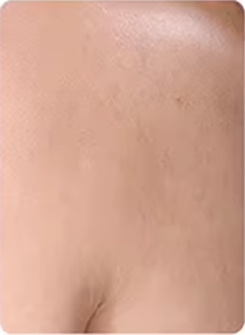 Dry Skin