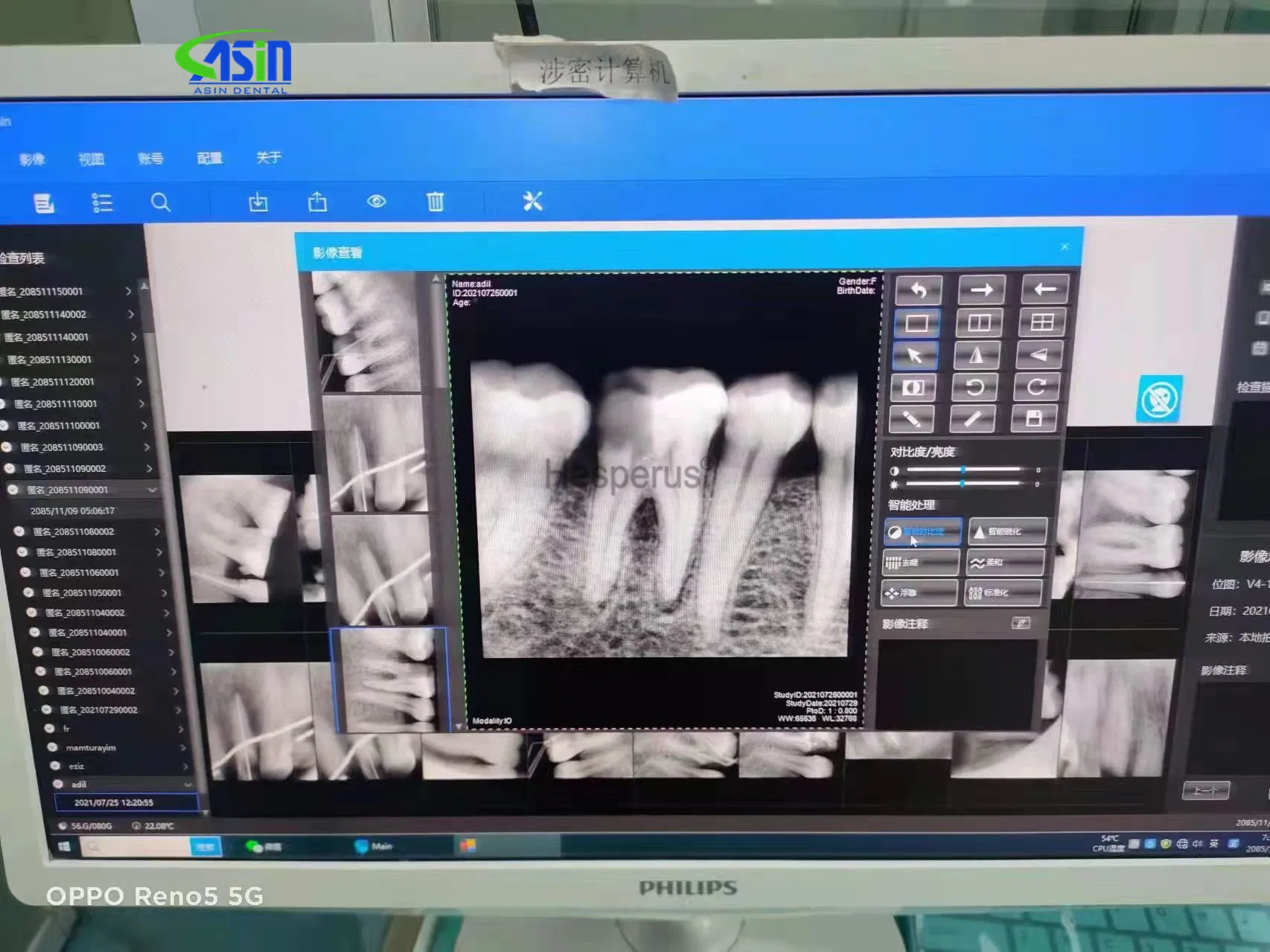 Dental Dynimage Sensor X-ray Sensor Digital Intraoral System