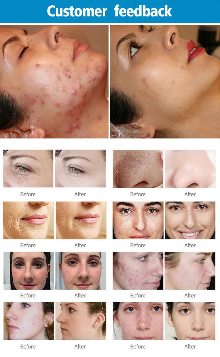 نتائج علاج ليزر CO2