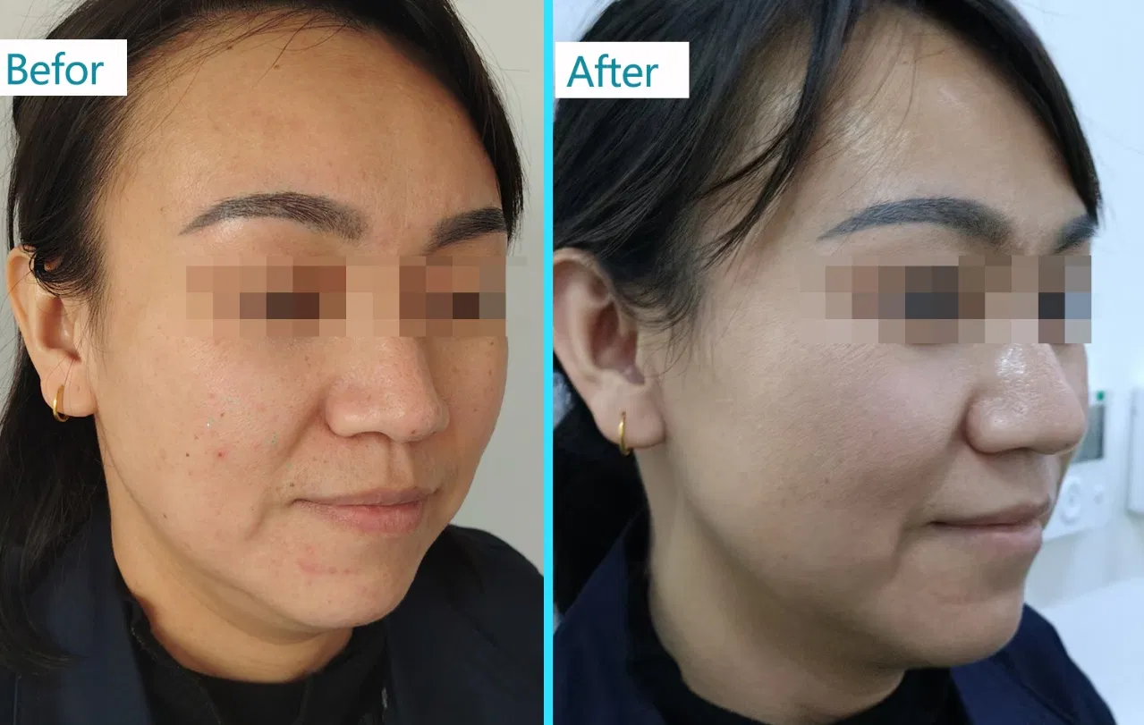 آلة إزالة الشعر بالليزر IPL لتجديد البشرة للاستخدام التجاري في صالونات التجميل
