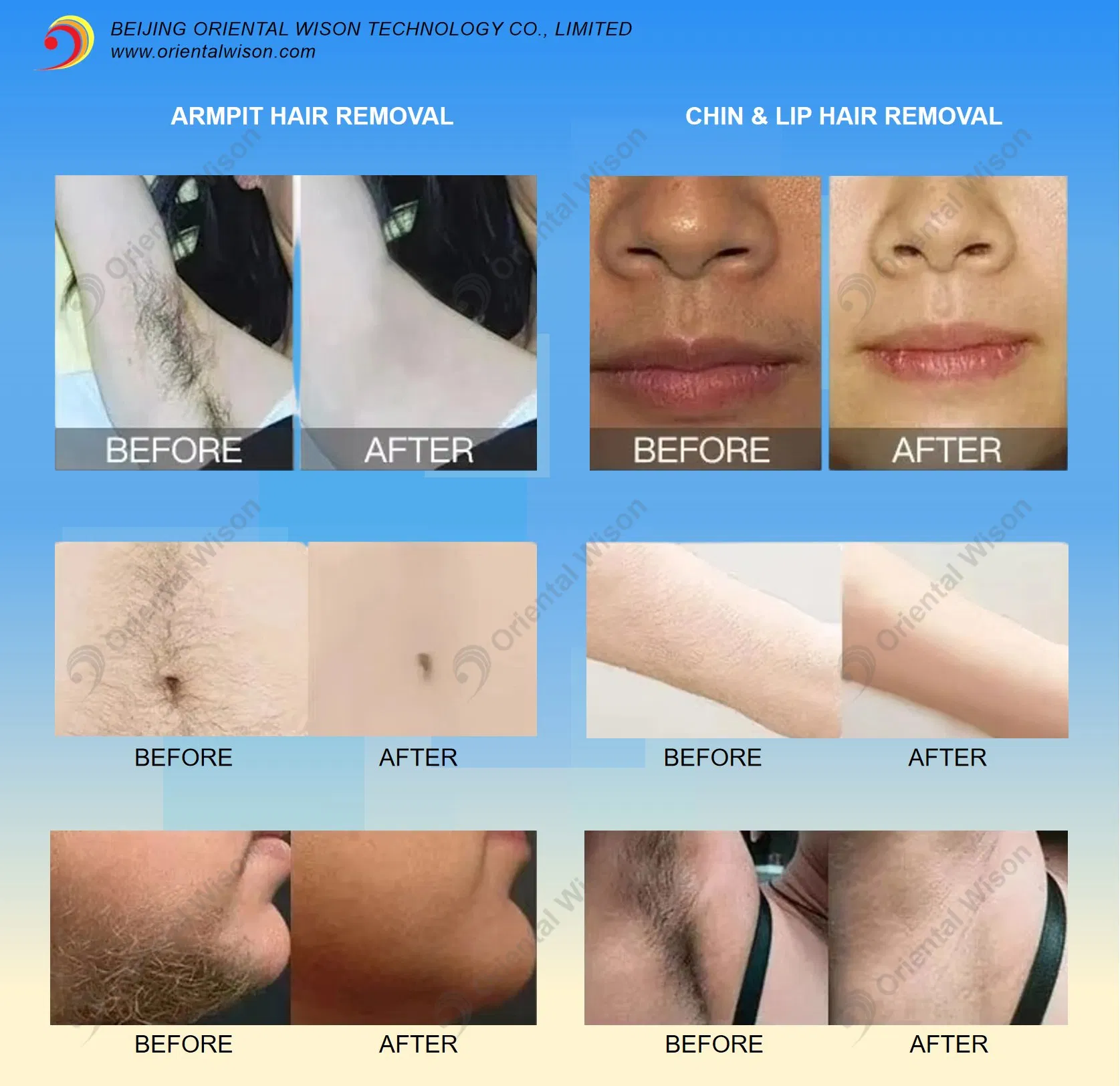 نتائج قبل وبعد إزالة الشعر بالليزر