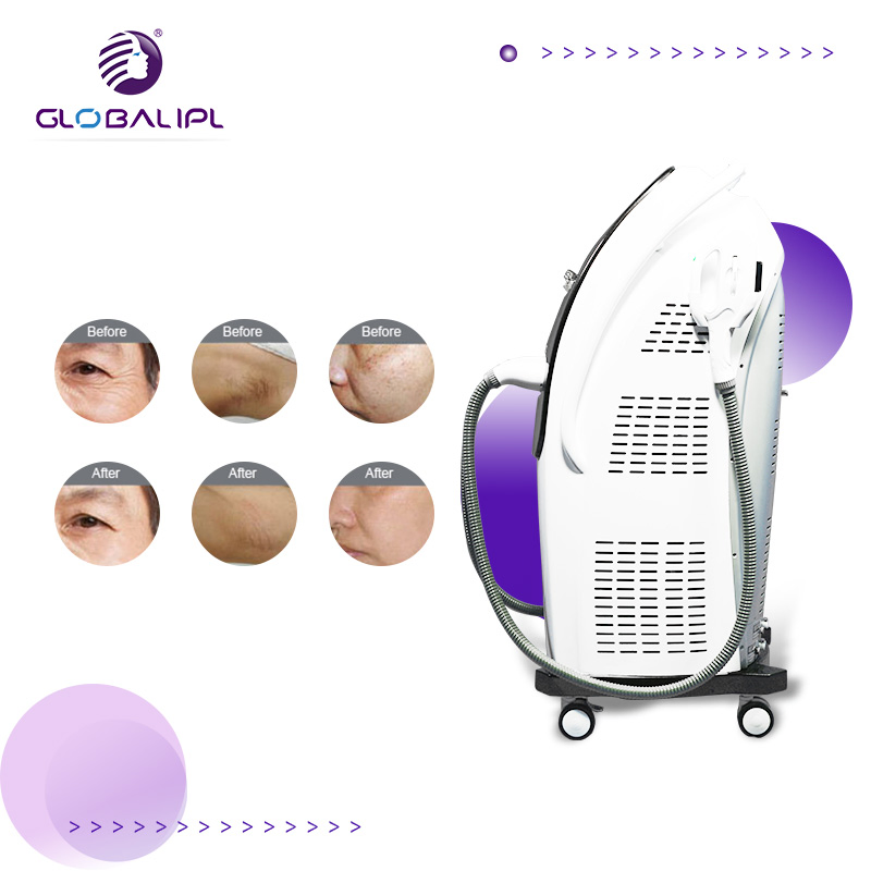 2020 منتجات جديدة 808nm ليزر ثنائي 755 808 1064 إزالة الشعر بالليزر آلة إزالة الشعر بالليزر سعر آلة الليزر ثنائي