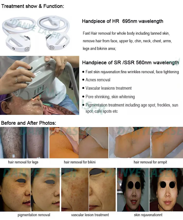 جهاز إزالة الشعر وعلاج تجديد البشرة من صالون كلينيك باستخدام تقنية IPL/Dpl