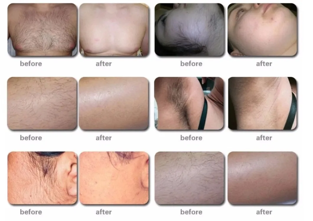 آلة إزالة الشعر بالليزر الدائم عالية الجودة 808nm خالية من الألم لصالون التجميل
