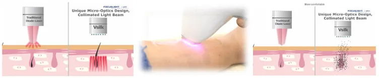 أفضل معدات جمال الليزر إزالة الشعر بالليزر 3 الطول الموجي 755 808 1064 آلة إزالة الشعر بالليزر الديود
