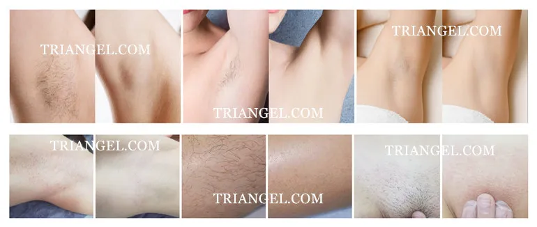 أفضل معدات جمال الليزر إزالة الشعر بالليزر 3 الطول الموجي 755 808 1064 آلة إزالة الشعر بالليزر الديود