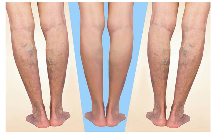 علاج الدوالي بالليزر 980nm نقل ألياف الليزر بالديود لجراحة EVLT minimally invasive