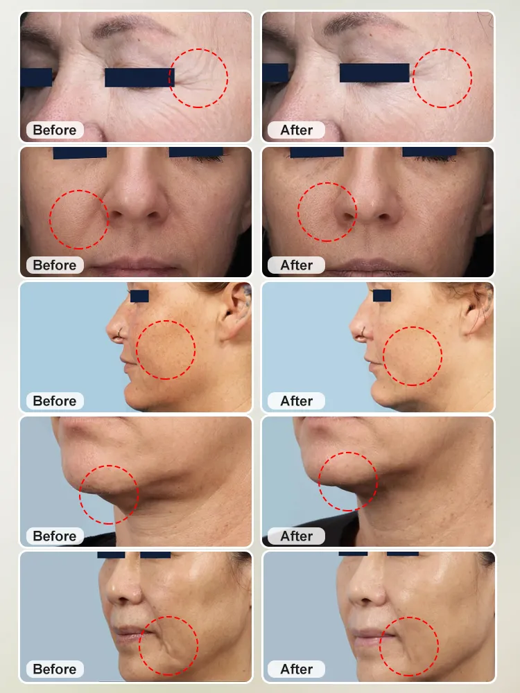 مورفيوس 8 جهاز تجميل بشرة الوجه بتقنية الإبر الدقيقة والترددات الراديوية لتحسين نعومة البشرة