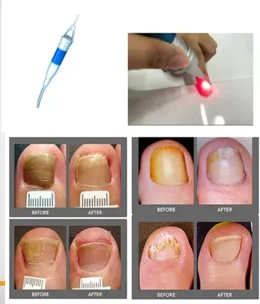 علاج فطريات الأظافر بالليزر