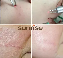 آلة شفط الدهون بالليزر 1470nm